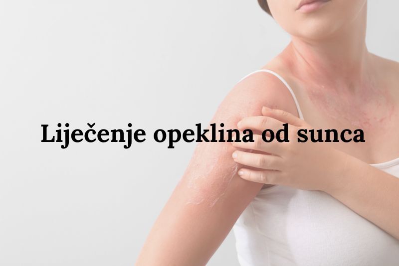 liječenje opeklina od sunca